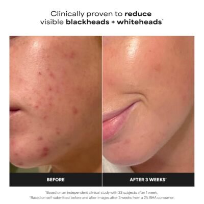 Paula's Choice SKIN PERFECTING 2% BHA Liquid Exfoliant, Gentle Salicylic Acid Facial Exfoliator for Blackheads, Enlarged Pores & Fine Lines - Image 10