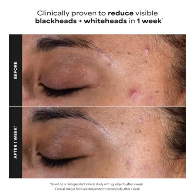 Paula's Choice SKIN PERFECTING 2% BHA Liquid Exfoliant, Gentle Salicylic Acid Facial Exfoliator for Blackheads, Enlarged Pores & Fine Lines - Image 8