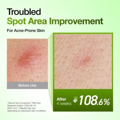 Anua Azelaic Acid 10 Hyaluron Redness Soothing Serum, Lightweight Blemish & Oil Care Facial Serum - Image 7